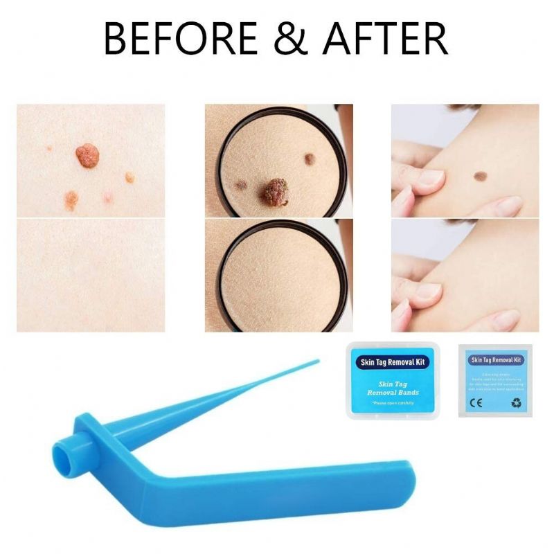 Home Micro Skin Tag Remover Set Medium Body Mole Wart Tag Band